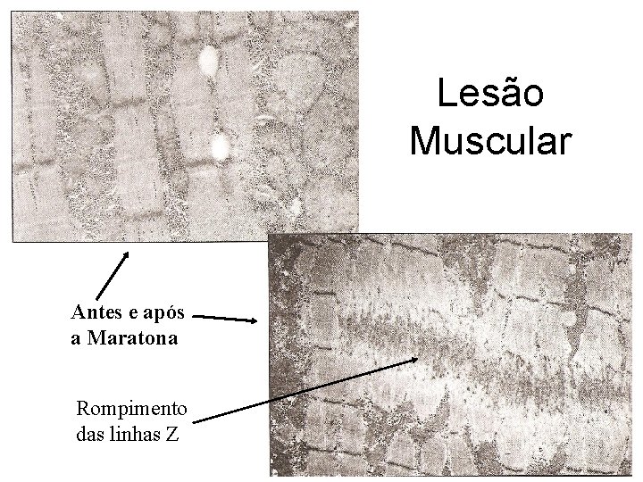 Lesão Muscular Antes e após a Maratona Rompimento das linhas Z 