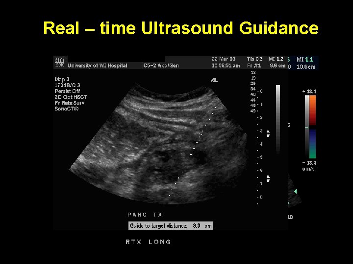 Real – time Ultrasound Guidance 