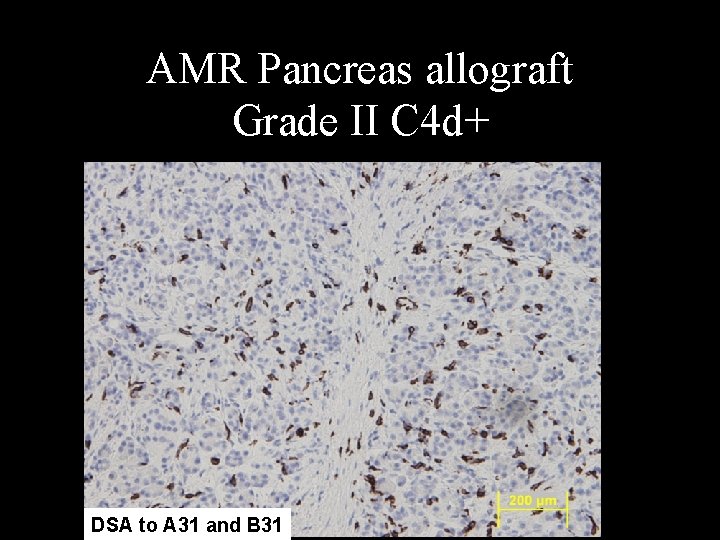 AMR Pancreas allograft Grade II C 4 d+ DSA to A 31 and B