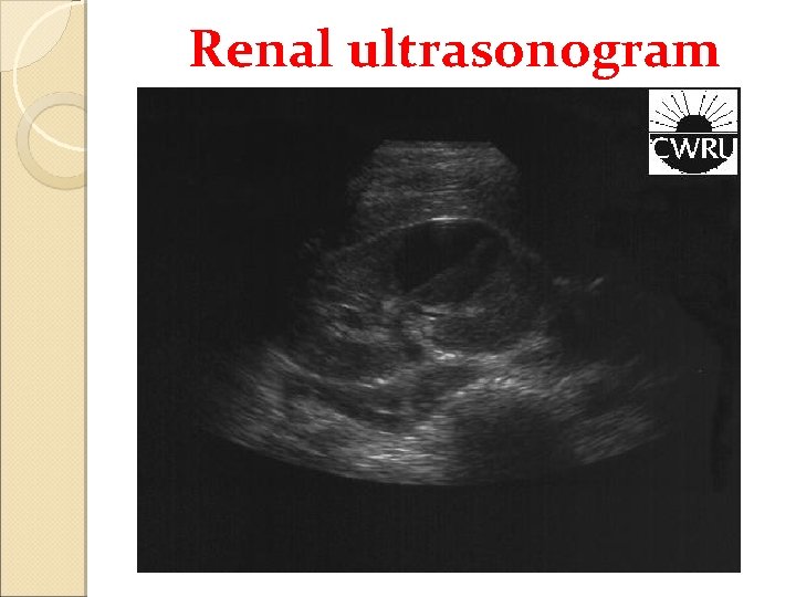 Renal ultrasonogram 