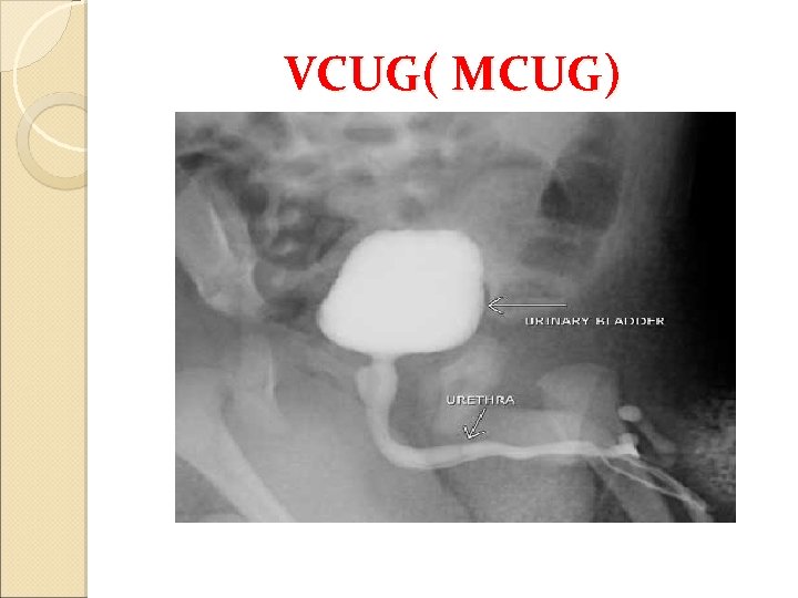 VCUG( MCUG) 