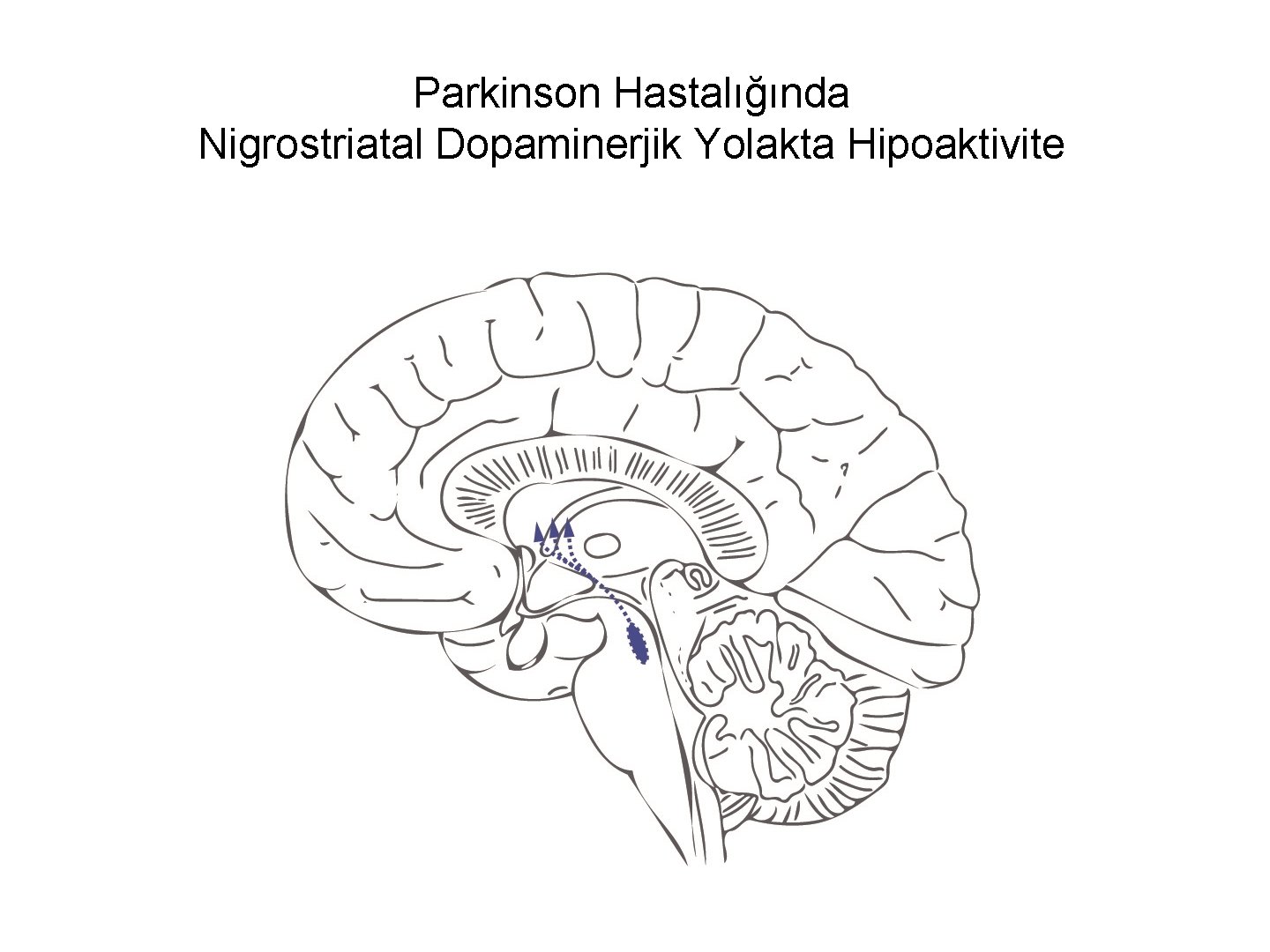 Parkinson Hastalığında Nigrostriatal Dopaminerjik Yolakta Hipoaktivite 