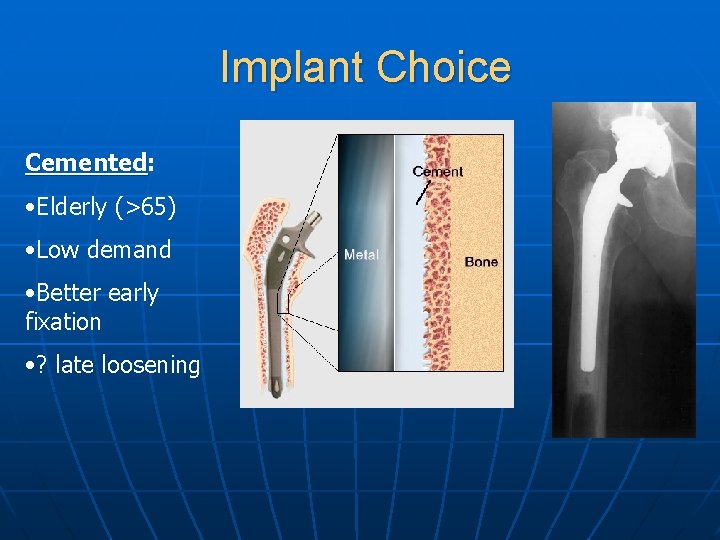 Implant Choice Cemented: Cemented • Elderly (>65) • Low demand • Better early fixation