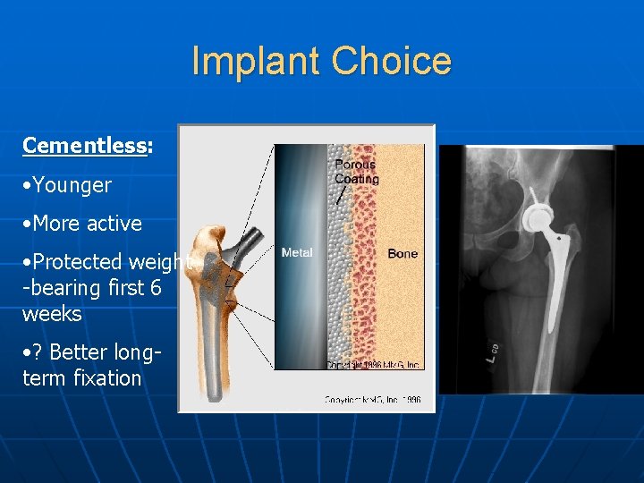 Implant Choice Cementless: Cementless • Younger • More active • Protected weight -bearing first