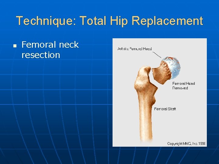 Technique: Total Hip Replacement n Femoral neck resection 