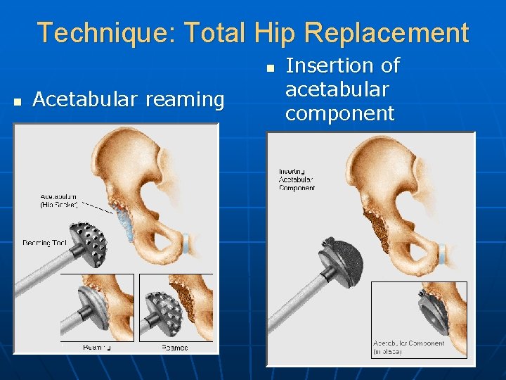 Technique: Total Hip Replacement n n Acetabular reaming Insertion of acetabular component 