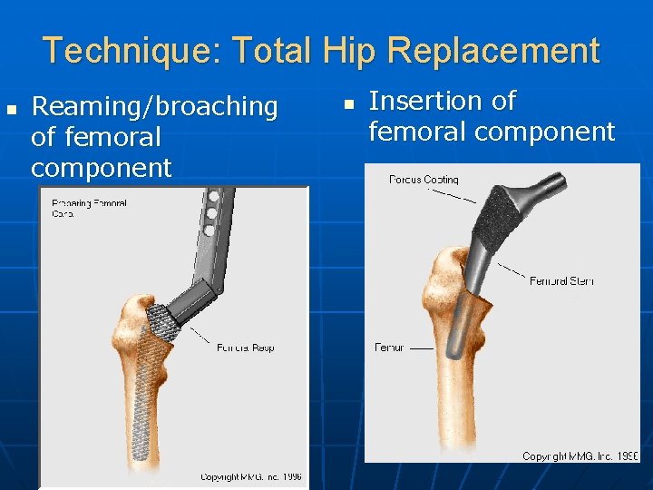 Technique: Total Hip Replacement n Reaming/broaching of femoral component n Insertion of femoral component