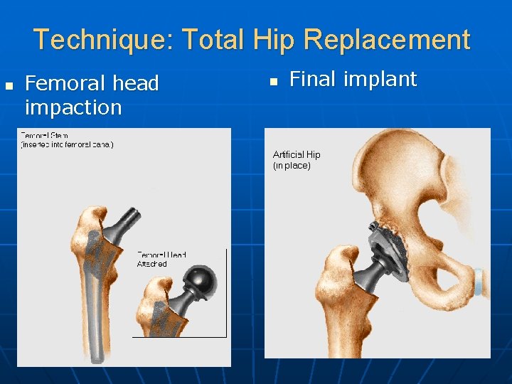 Technique: Total Hip Replacement n Femoral head impaction n Final implant 