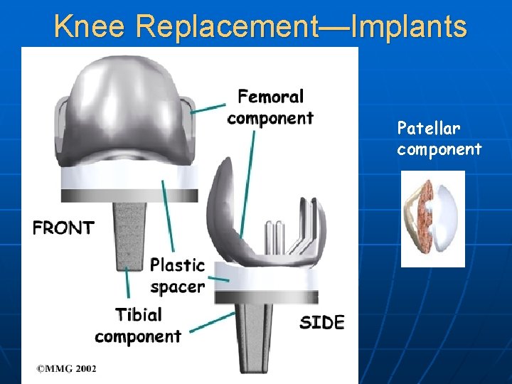Knee Replacement—Implants Patellar component 