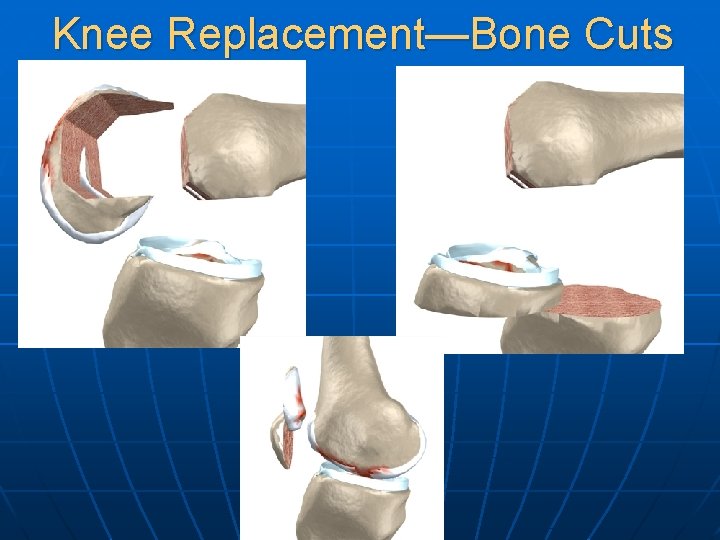 Knee Replacement—Bone Cuts 