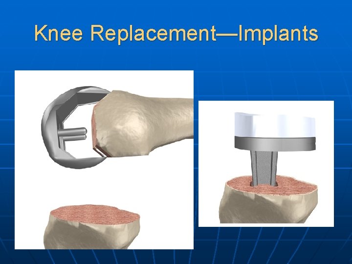 Knee Replacement—Implants 