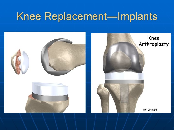 Knee Replacement—Implants 