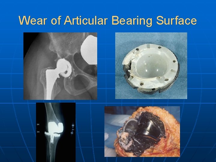 Wear of Articular Bearing Surface 