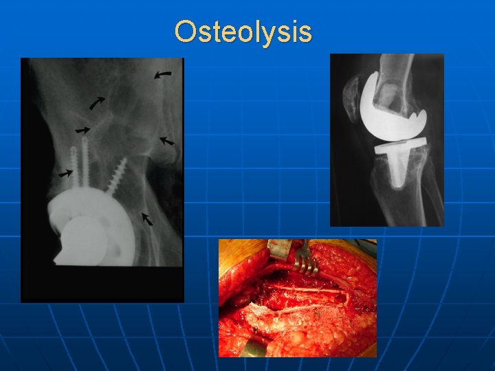 Osteolysis 
