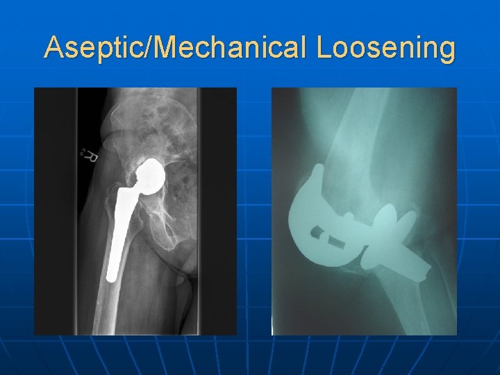 Aseptic/Mechanical Loosening 