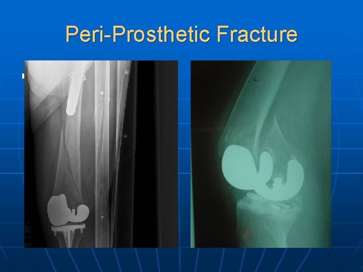 Peri-Prosthetic Fracture n Sri: PP fracture 