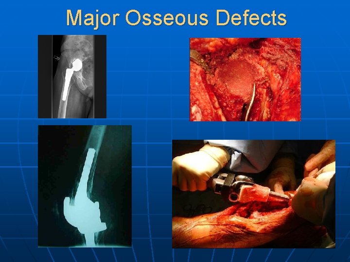 Major Osseous Defects 