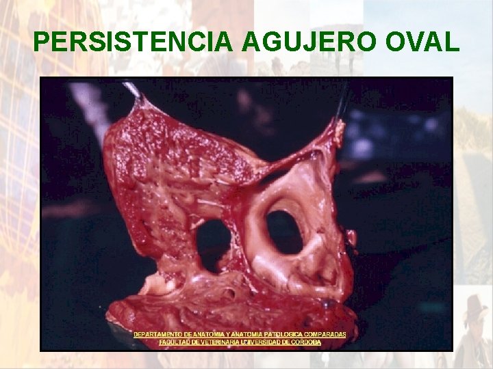 PERSISTENCIA AGUJERO OVAL * PERSISTENCIA AGUJERO OVAL *