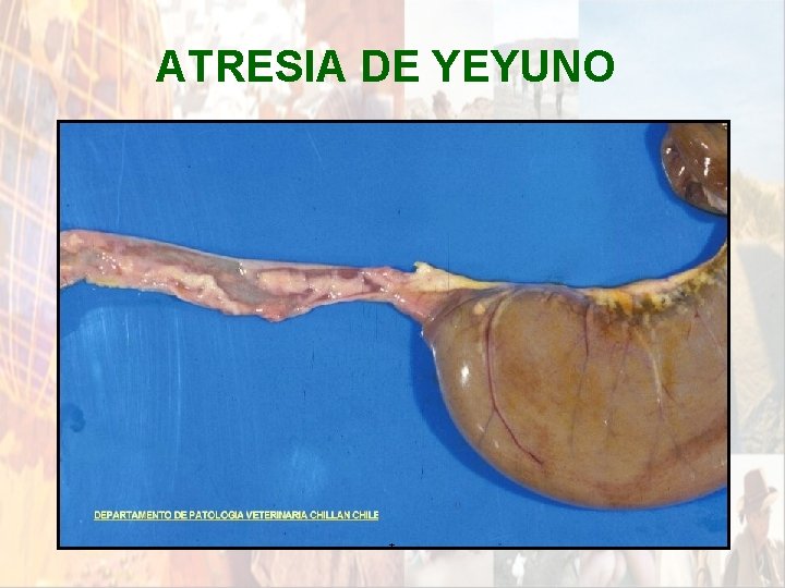 ATRESIA DE YEYUNO * ATRESIA DE YEYUNO *