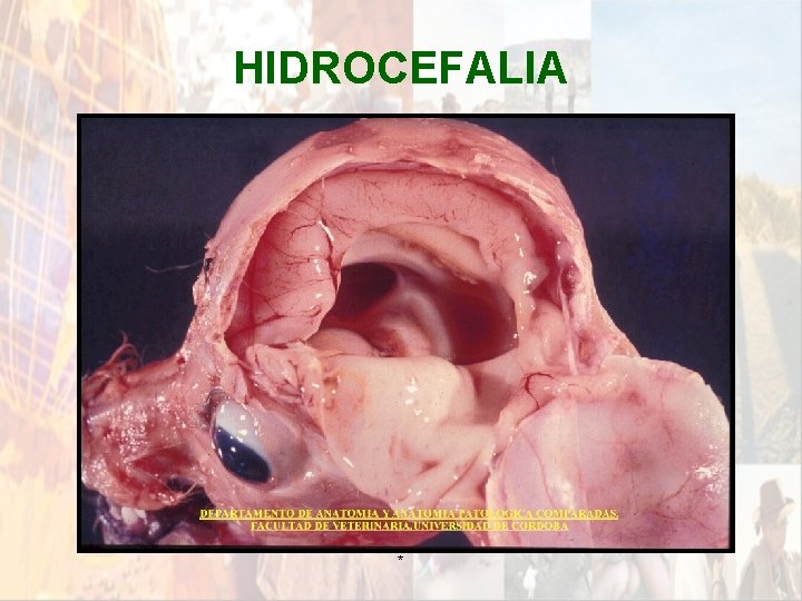 HIDROCEFALIA * HIDROCEFALIA *