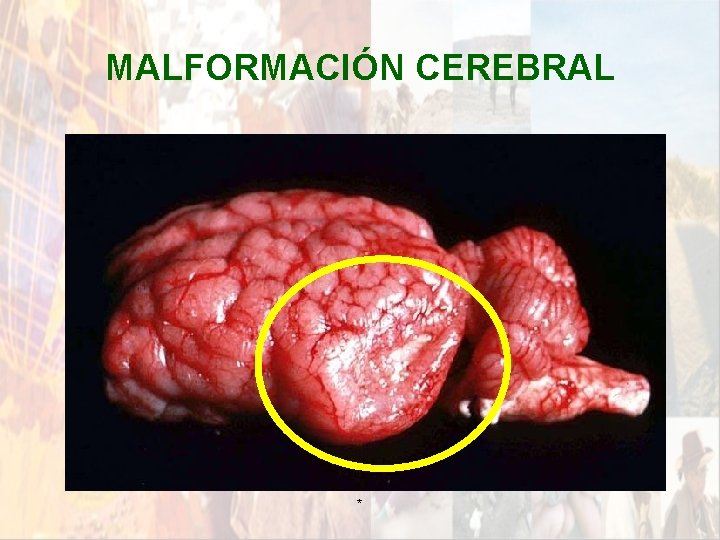 MALFORMACIÓN CEREBRAL * MALFORMACIÓN CEREBRAL *