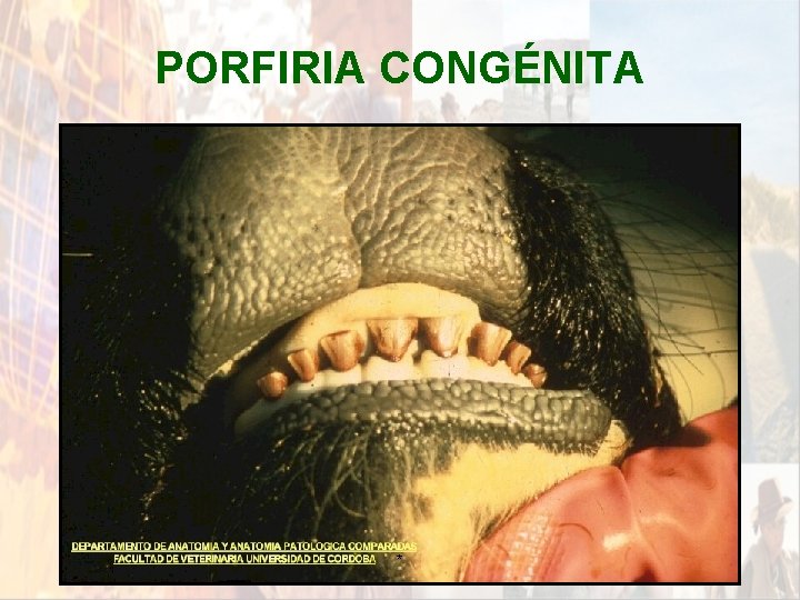 PORFIRIA CONGÉNITA * PORFIRIA CONGÉNITA *