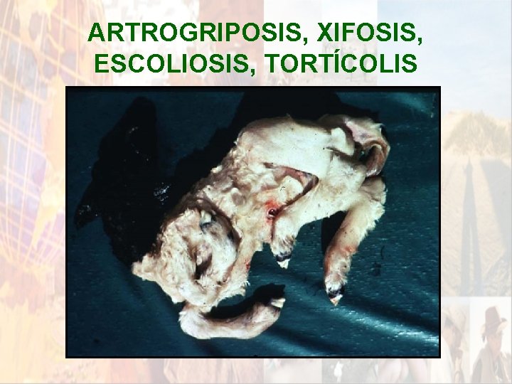 ARTROGRIPOSIS, XIFOSIS, ESCOLIOSIS, TORTÍCOLIS * ARTROGRIPOSIS, XIFOSIS, ESCOLIOSIS, TORTÍCOLIS *