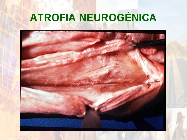ATROFIA NEUROGÉNICA * ATROFIA NEUROGÉNICA *