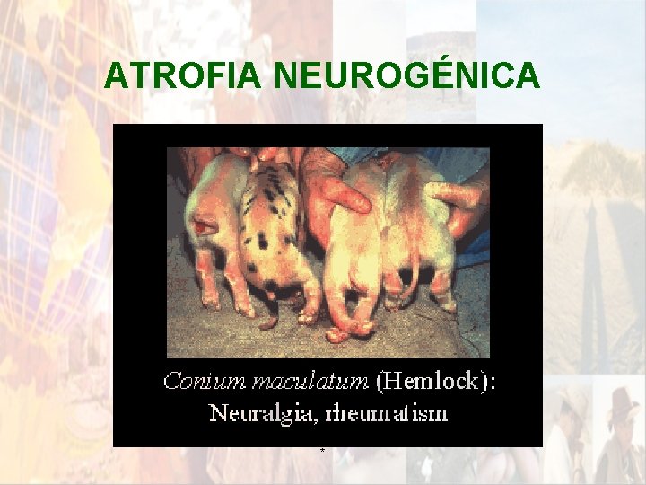 ATROFIA NEUROGÉNICA * ATROFIA NEUROGÉNICA *