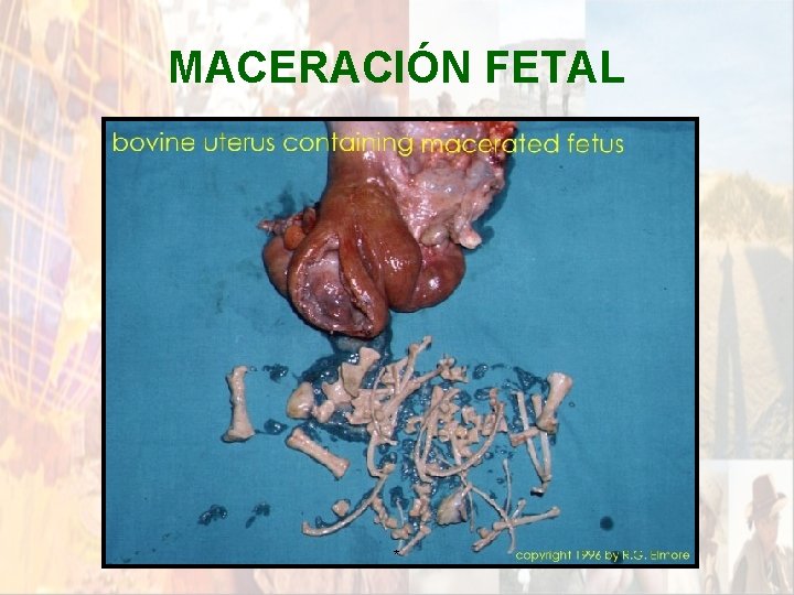MACERACIÓN FETAL * MACERACIÓN FETAL *
