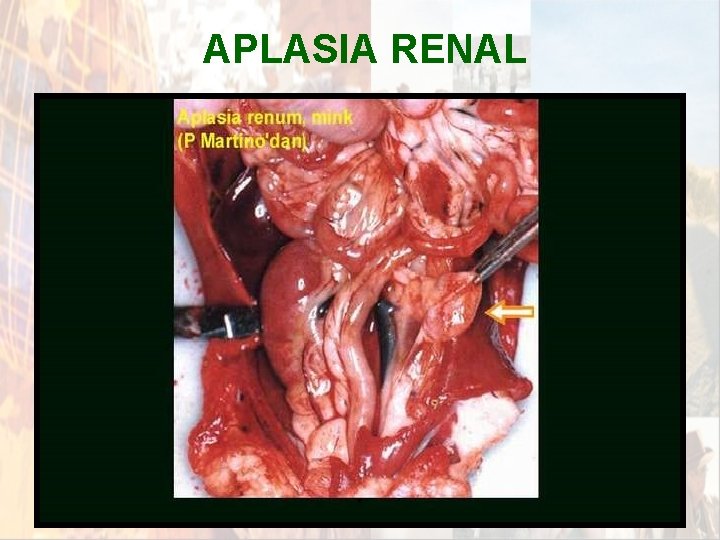 APLASIA RENAL * APLASIA RENAL *