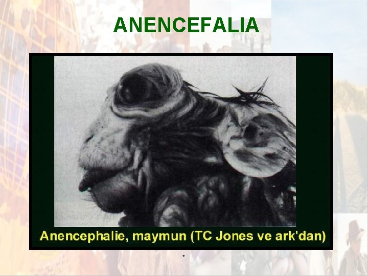 ANENCEFALIA * ANENCEFALIA *