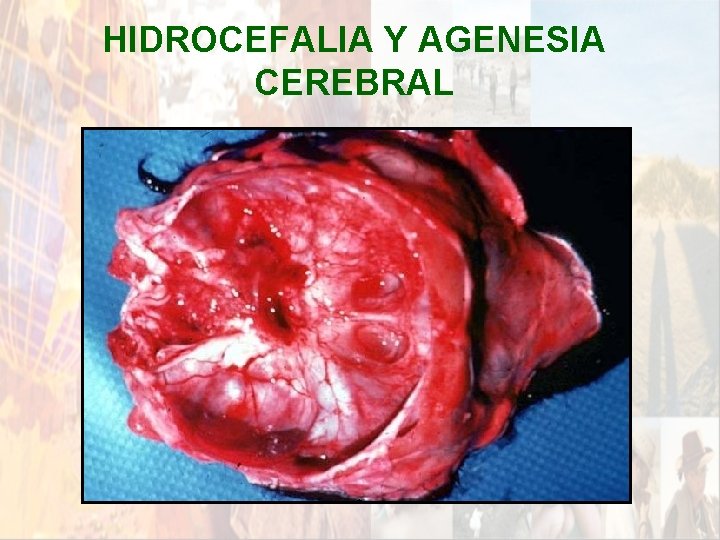 HIDROCEFALIA Y AGENESIA CEREBRAL * HIDROCEFALIA Y AGENESIA CEREBRAL *