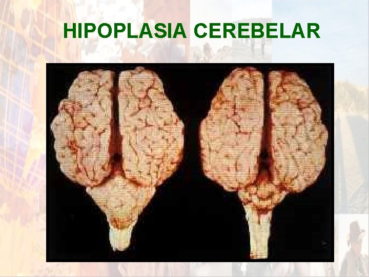 HIPOPLASIA CEREBELAR * HIPOPLASIA CEREBELAR *