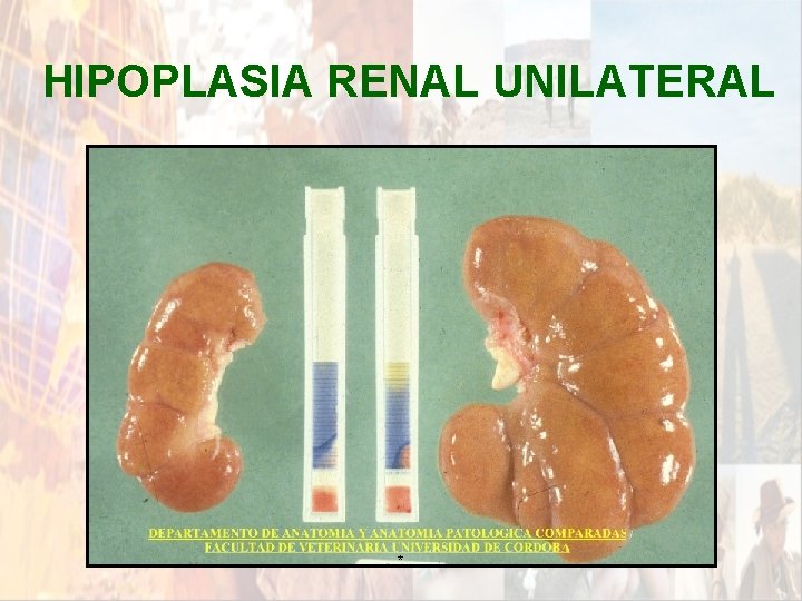 HIPOPLASIA RENAL UNILATERAL * HIPOPLASIA RENAL UNILATERAL *