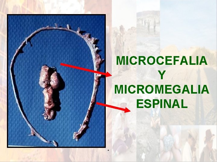 MICROCEFALIA Y MICROMEGALIA ESPINAL * MICROCEFALIA Y MICROMEGALIA ESPINAL *