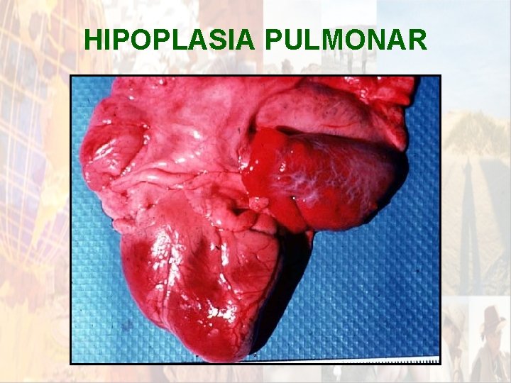 HIPOPLASIA PULMONAR * HIPOPLASIA PULMONAR *