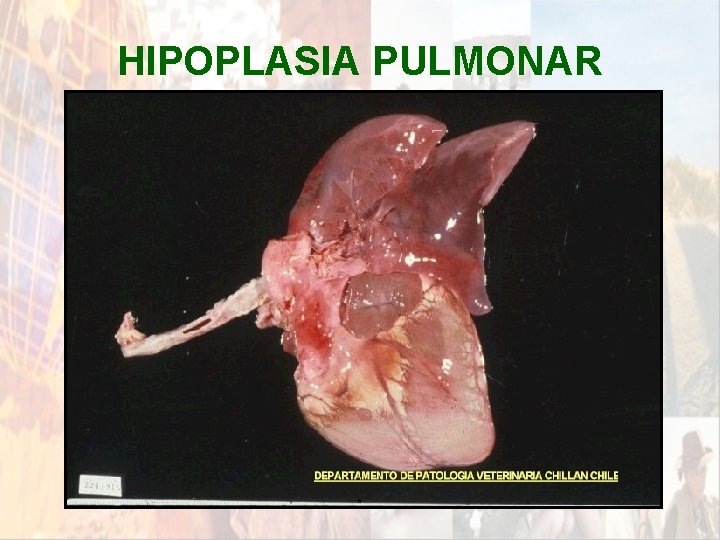 HIPOPLASIA PULMONAR * HIPOPLASIA PULMONAR *