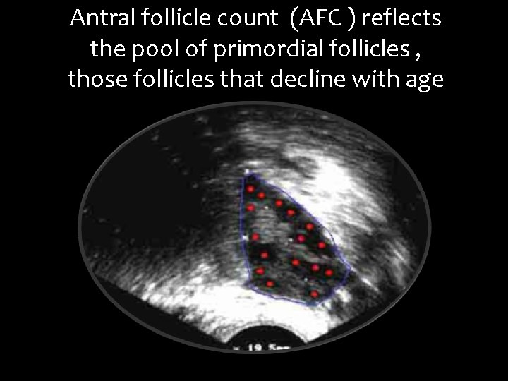 Antral follicle count (AFC ) reflects the pool of primordial follicles , those follicles