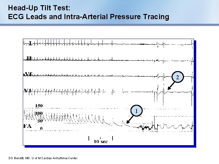 Head-Up Tilt Test: ECG Leads and Intra-Arterial Pressure Tracing 2 1 DG Benditt, MD.