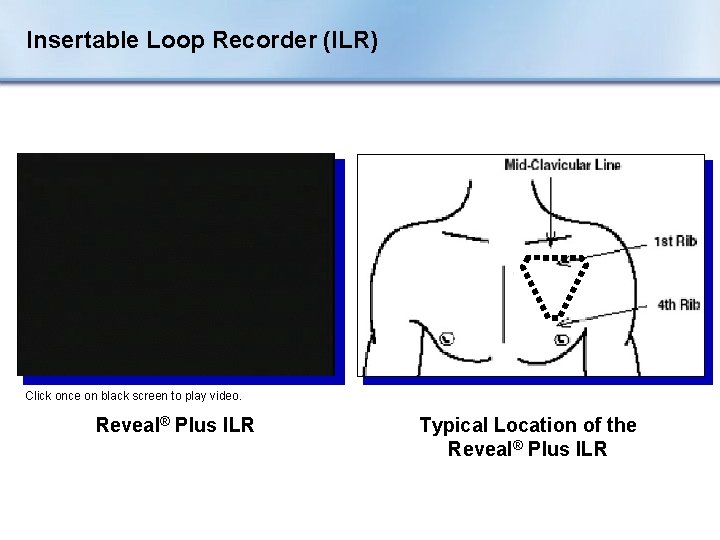 Insertable Loop Recorder (ILR) Click once on black screen to play video. Reveal® Plus