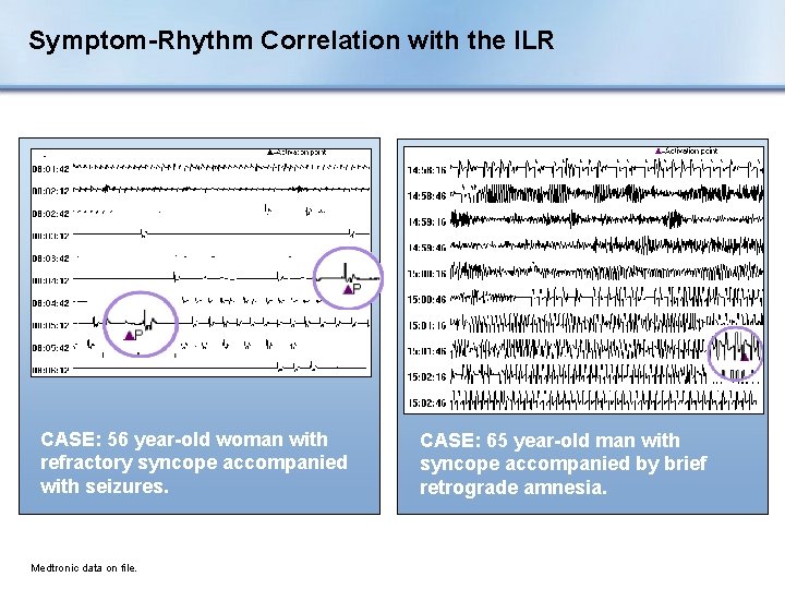 Symptom-Rhythm Correlation with the ILR CASE: 56 year-old woman with refractory syncope accompanied with