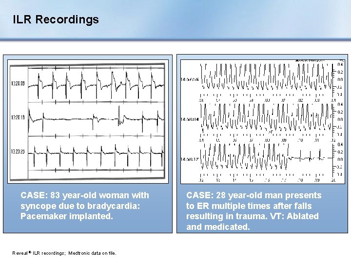 ILR Recordings CASE: 83 year-old woman with syncope due to bradycardia: Pacemaker implanted. Reveal