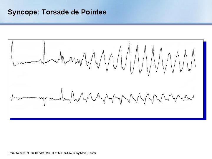 Syncope: Torsade de Pointes From the files of DG Benditt, MD. U of M