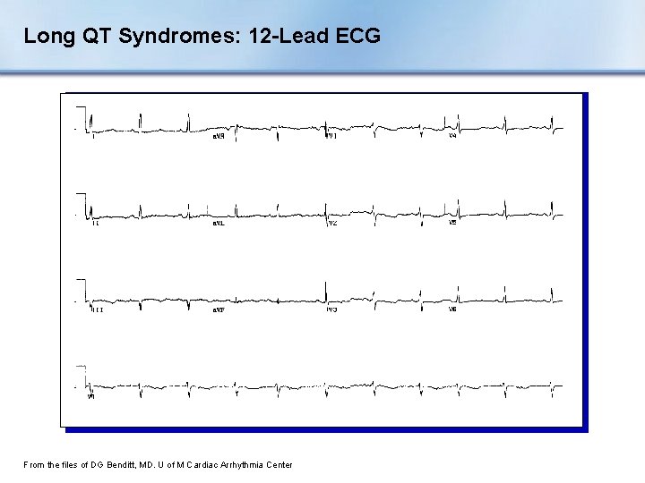 Long QT Syndromes: 12 -Lead ECG From the files of DG Benditt, MD. U