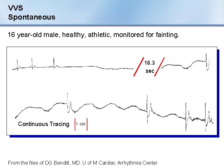 VVS Spontaneous 16 year-old male, healthy, athletic, monitored for fainting. 16. 3 sec Continuous