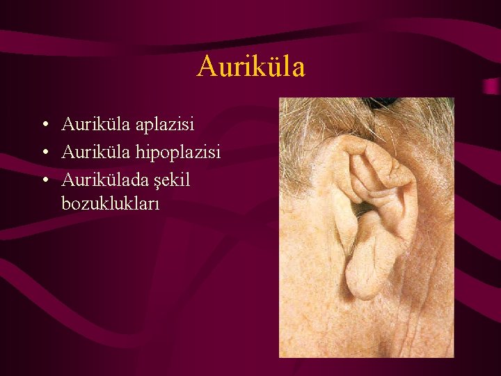 Auriküla • Auriküla aplazisi • Auriküla hipoplazisi • Aurikülada şekil bozuklukları 