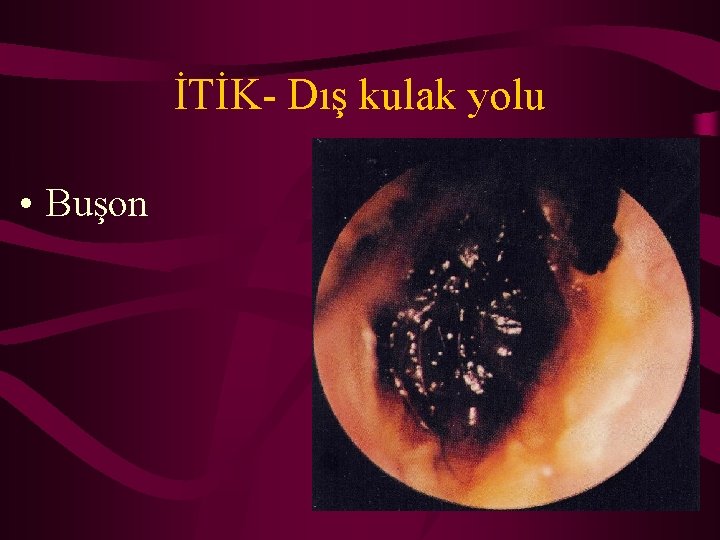 İTİK- Dış kulak yolu • Buşon 