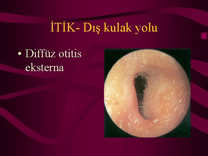 İTİK- Dış kulak yolu • Diffüz otitis eksterna 