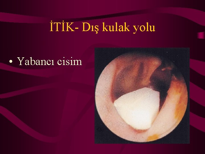 İTİK- Dış kulak yolu • Yabancı cisim 